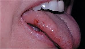 Bitten lip or tongue